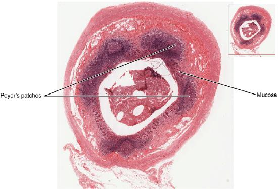 Micrograph of MALT nodule